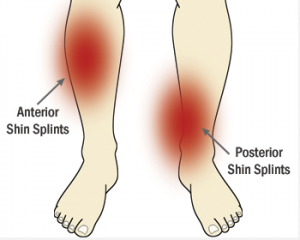 Shin Splints Explained for All Runners and Good News for Sufferers