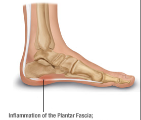 How Runners Can Avoid Plantar Fasciitis 